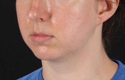 Chin Implant Before & After Patient #1562