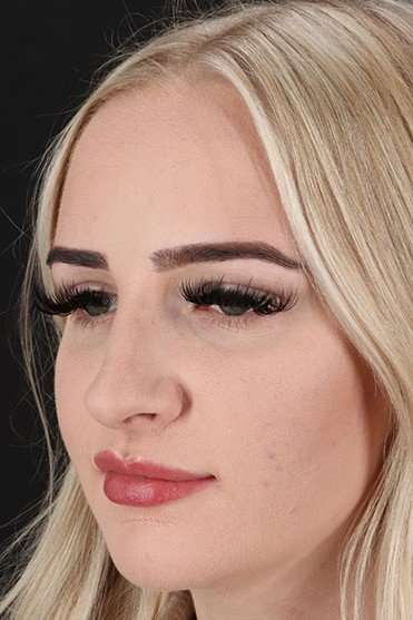 Browlift Before & After Patient #1242