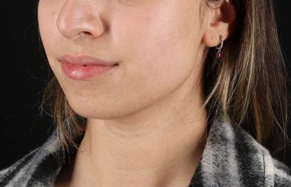 Chin Implant Before & After Patient #1573