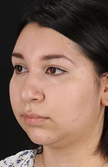 Chin Implant Before & After Patient #1604