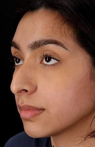 Chin Implant Before & After Patient #1637