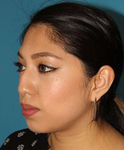 Chin Implant Before & After Patient #1670