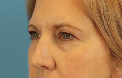 Eyelid Lift Before & After Patient #1747
