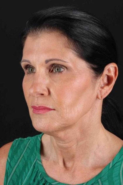 Facelift Before & After Patient #1854