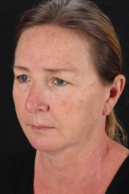 Browlift Before & After Patient #1264