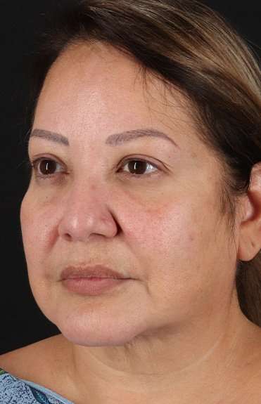 Facelift Before & After Patient #1888