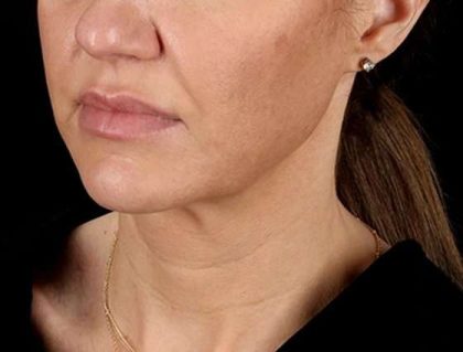 Facelift Before & After Patient #1921