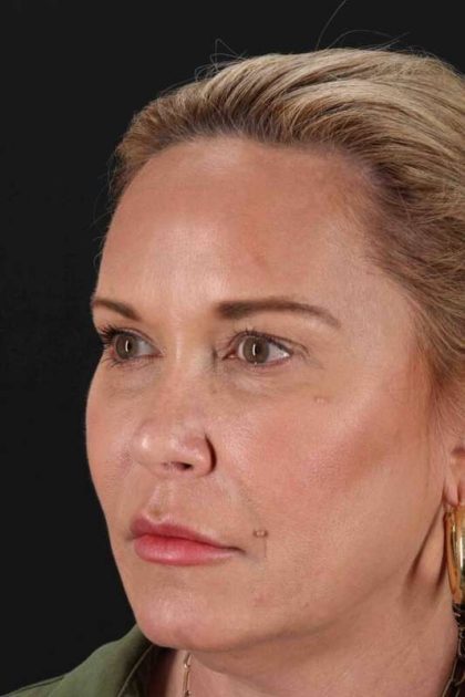 Facelift Before & After Patient #1954