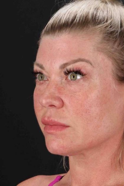 Fat Grafting To The Face Before & After Patient #2016