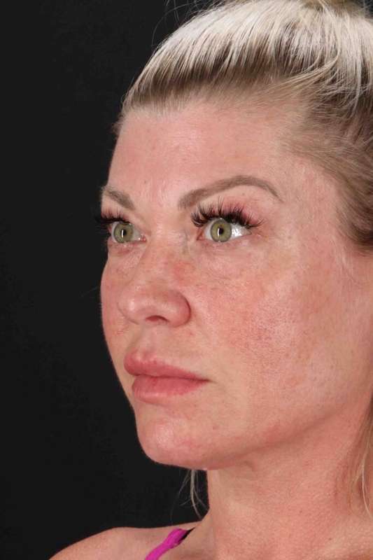 Fat Grafting To The Face Before & After Patient #2016