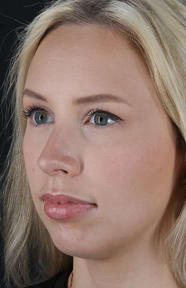 Fillers Before & After Patient #2030