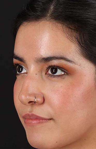 Fillers Before & After Patient #2041