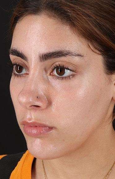 Fillers Before & After Patient #2052