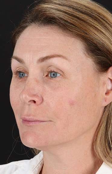 Lip Lift Before & After Patient #2144
