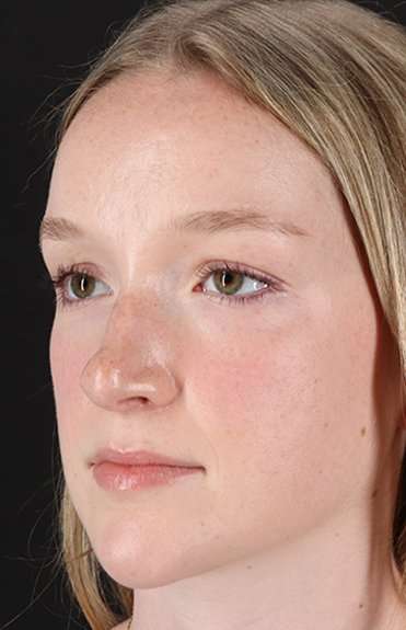 Liquid Rhinoplasty Before & After Patient #2177