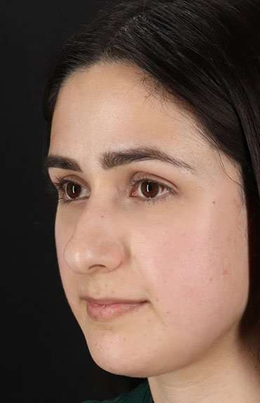 Liquid Rhinoplasty Before & After Patient #2188