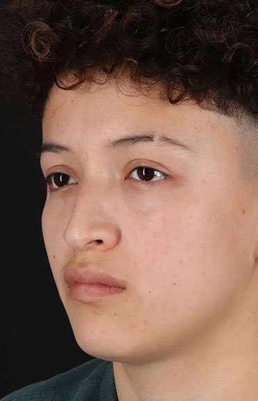 Liquid Rhinoplasty Before & After Patient #2199