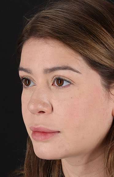 Liquid Rhinoplasty Before & After Patient #2210