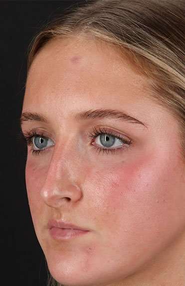 Liquid Rhinoplasty Before & After Patient #2221