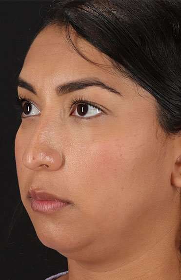 Liquid Rhinoplasty Before & After Patient #2232
