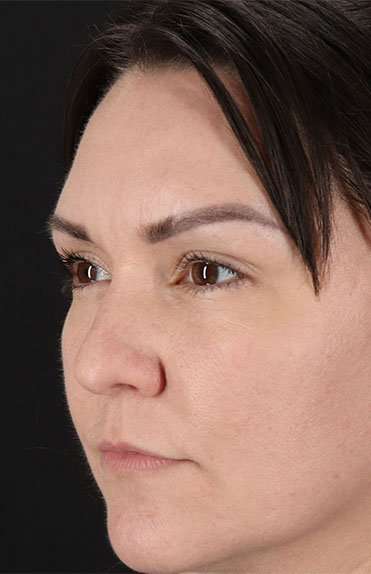 Liquid Rhinoplasty Before & After Patient #2243