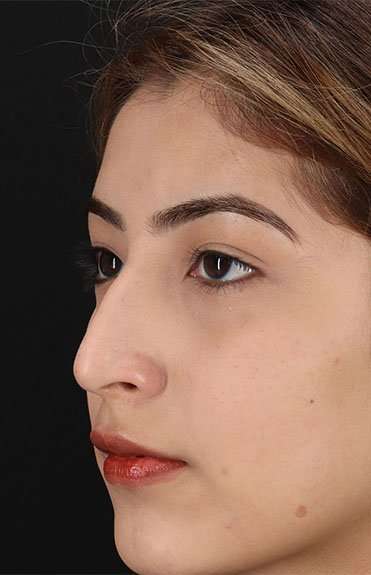 Liquid Rhinoplasty Before & After Patient #2254