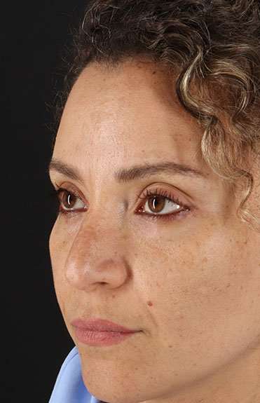 Liquid Rhinoplasty Before & After Patient #2276