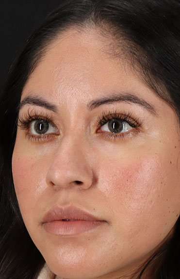 Liquid Rhinoplasty Before & After Patient #2290