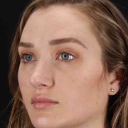 Browlift Before & After Patient #1297