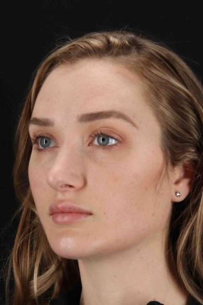 Browlift Before & After Patient #1297