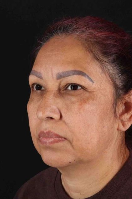 Lower Blepharoplasty Before & After Patient #2321