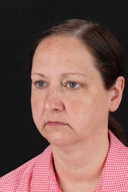 Lower Blepharoplasty Before & After Patient #2354