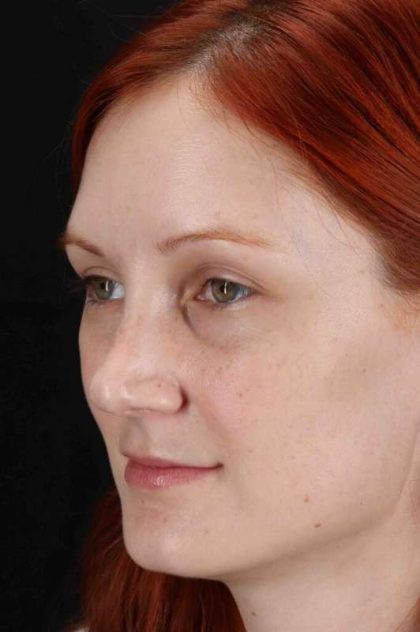 Lower Blepharoplasty Before & After Patient #2409
