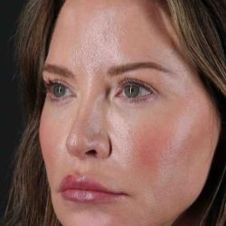 Browlift Before & After Patient #1308