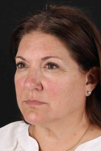 Neck Lift Before & After Patient #2463