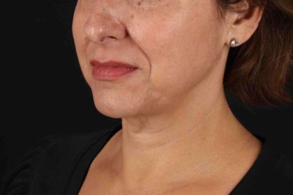 Neck Lift Before & After Patient #2472