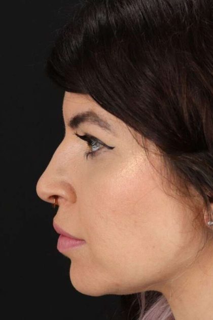 Browlift Before & After Patient #1220