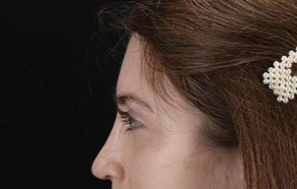 Browlift Before & After Patient #1319