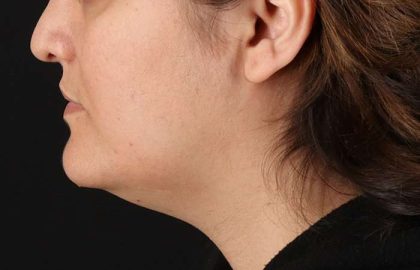 Neck Lift Before & After Patient #2560
