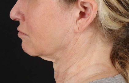 Neck Lift Before & After Patient #2571