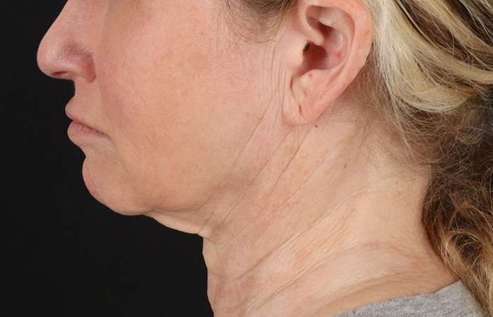 Neck Lift Before & After Patient #2571