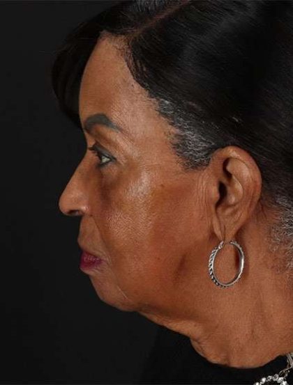 Neck Lift Before & After Patient #2615