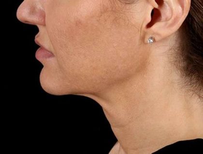 Neck Lift Before & After Patient #2626