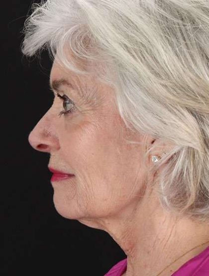 Neck Lift Before & After Patient #2637