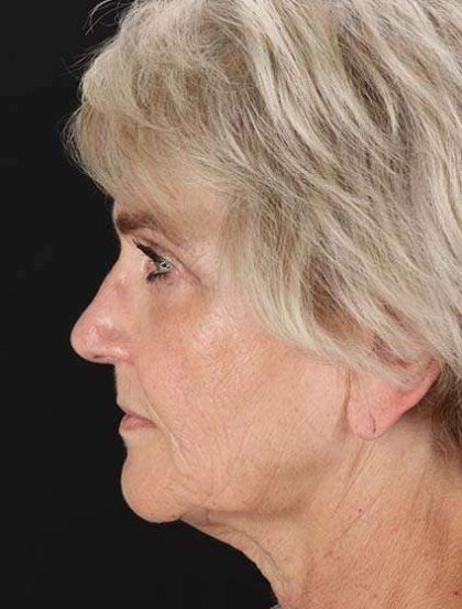Neck Lift Before & After Patient #2648