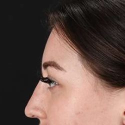 Browlift Before & After Patient #1330