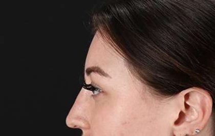Browlift Before & After Patient #1330