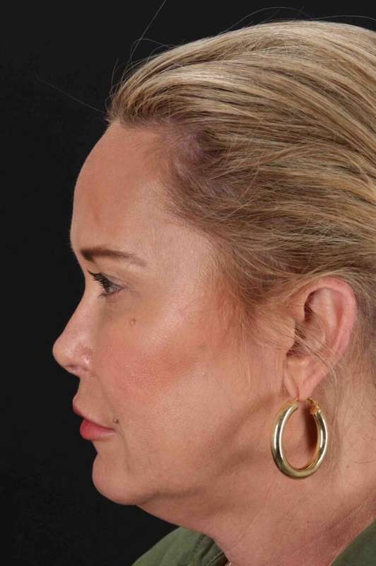 Neck Lift Before & After Patient #2659