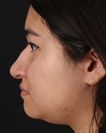 Neck Liposuction Before & After Patient #2730