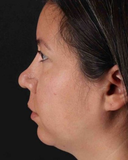 Neck Liposuction Before & After Patient #2741